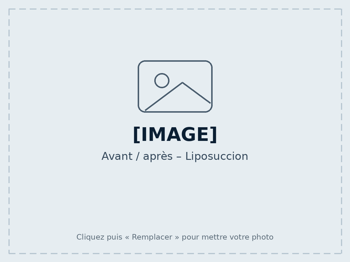 Before / after – Liposuction