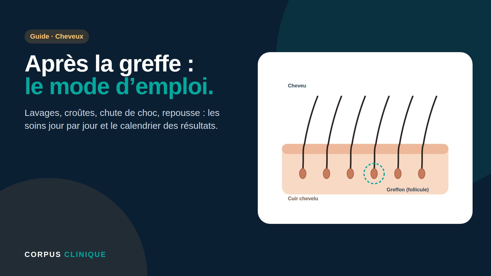 Soins après une greffe de cheveux