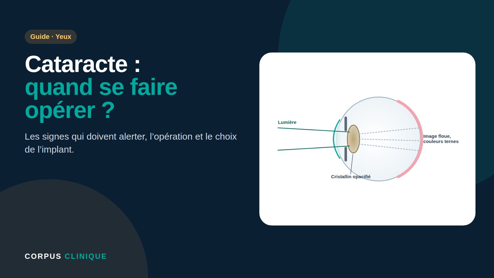 Cataracte : quand se faire opérer