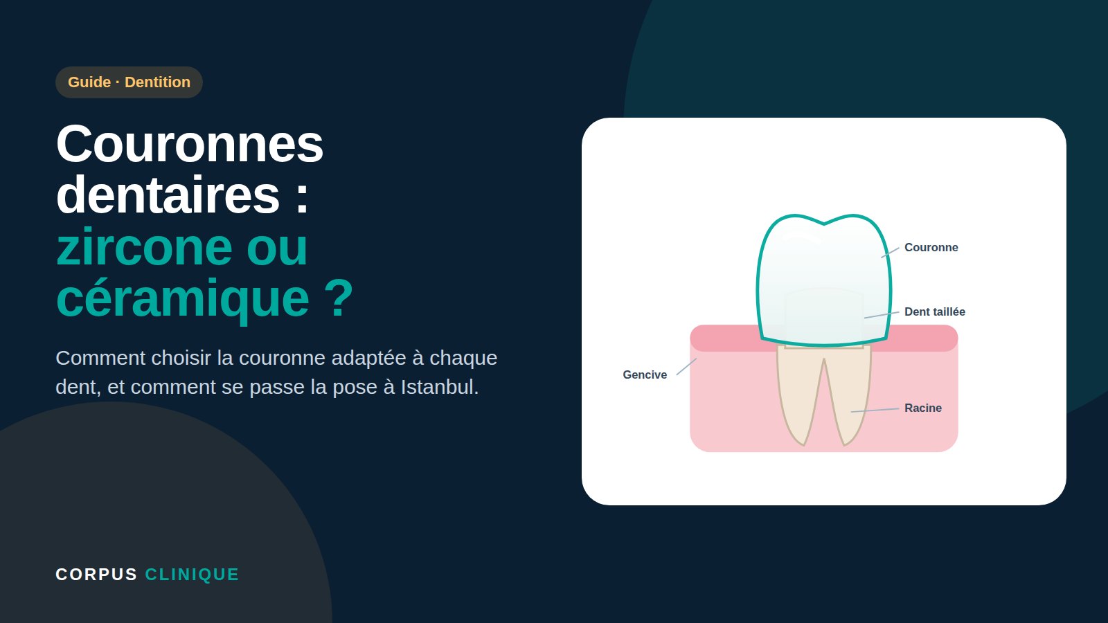 Couronnes dentaires en zircone ou céramique