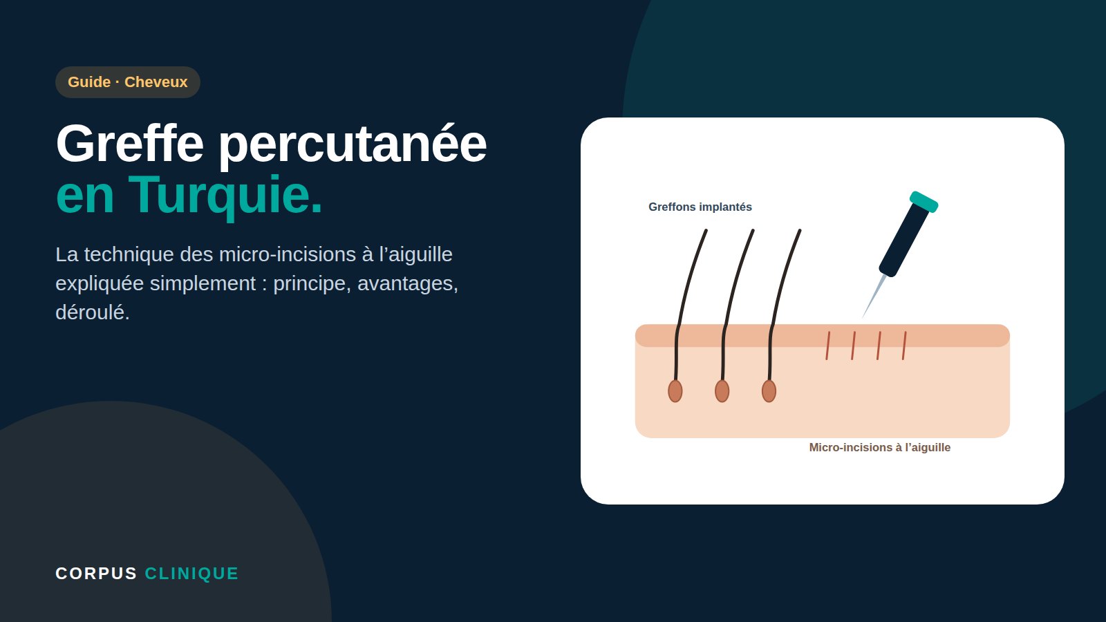 Greffe de cheveux percutanée en Turquie