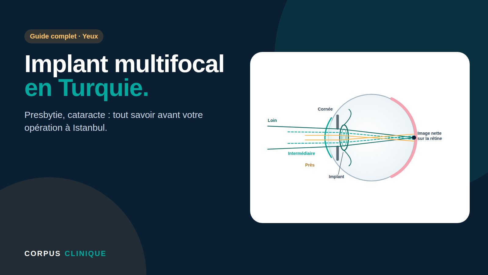 Implant multifocal en Turquie – guide complet