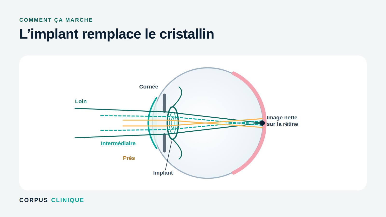 Schéma de l’œil : l’implant multifocal remplace le cristallin et fait converger la vision de loin, intermédiaire et de près sur la rétine